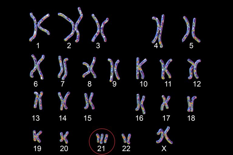 Understanding How A Doctor Diagnoses Down Syndrome