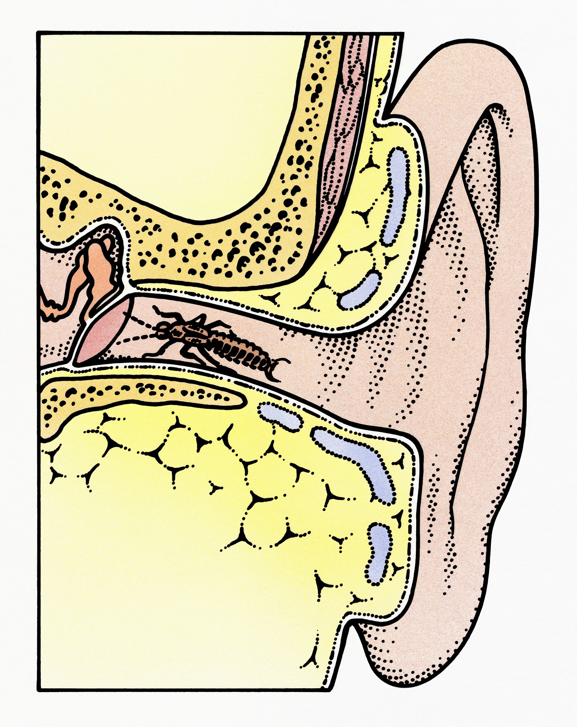 earwig-bite-images-symptoms-marks-treatment-earwig-bite-in-ear