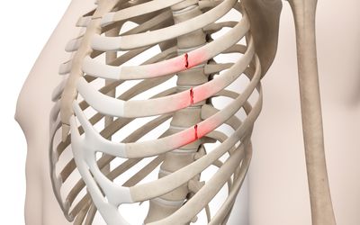 Broken Rib Symptoms, Complications, And Treatment