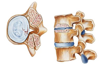 Neuroforaminal Stenosis Defined