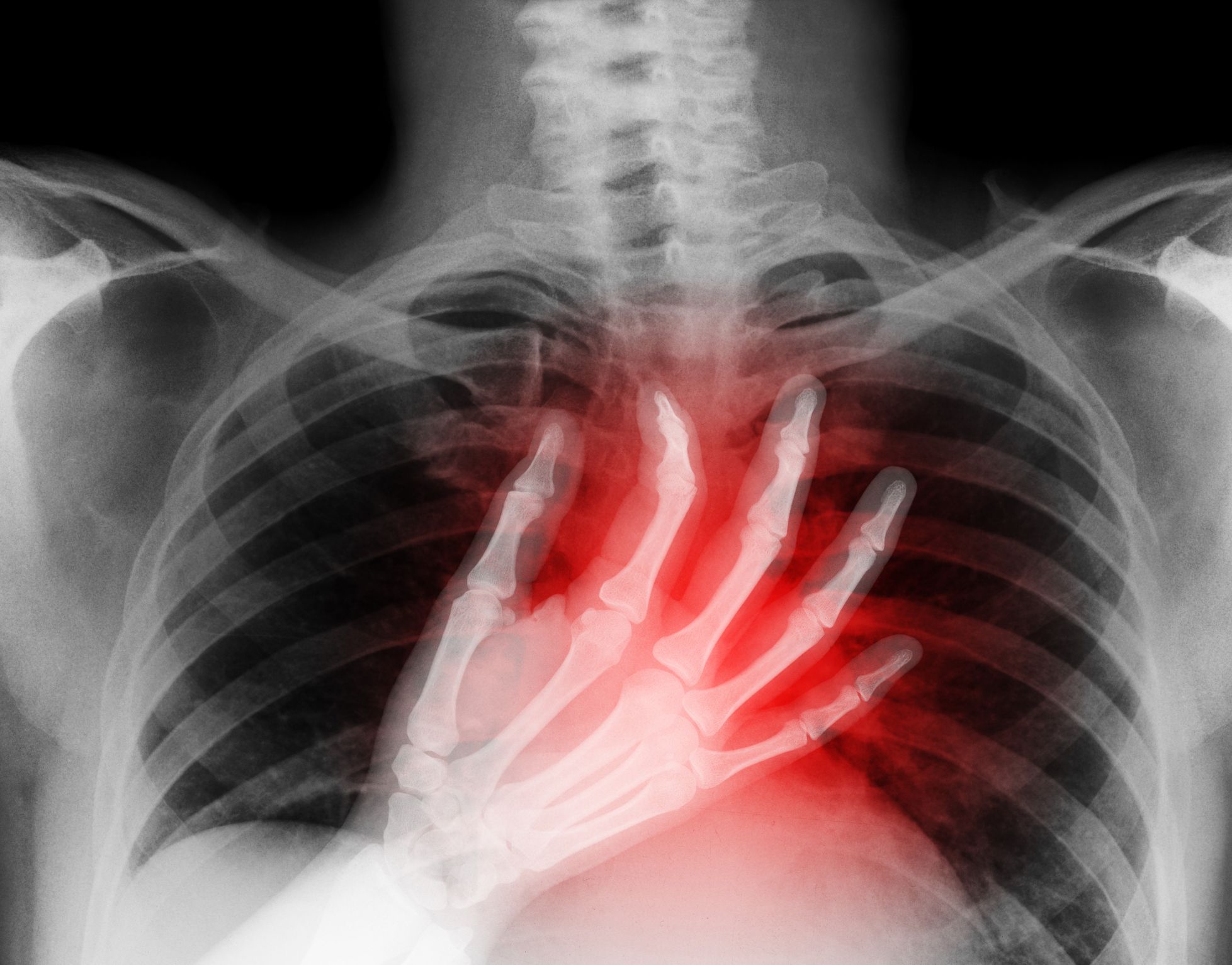 Costochondritis Causes, Symptoms, and Treatment