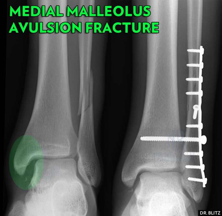 radial lateral malleolus fracture