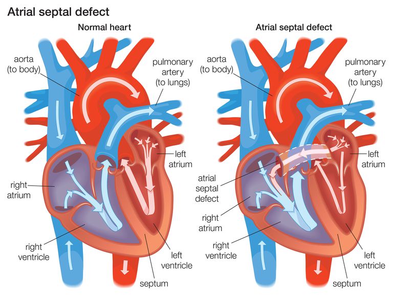 Atrial Septal Defect (ASD) Explained