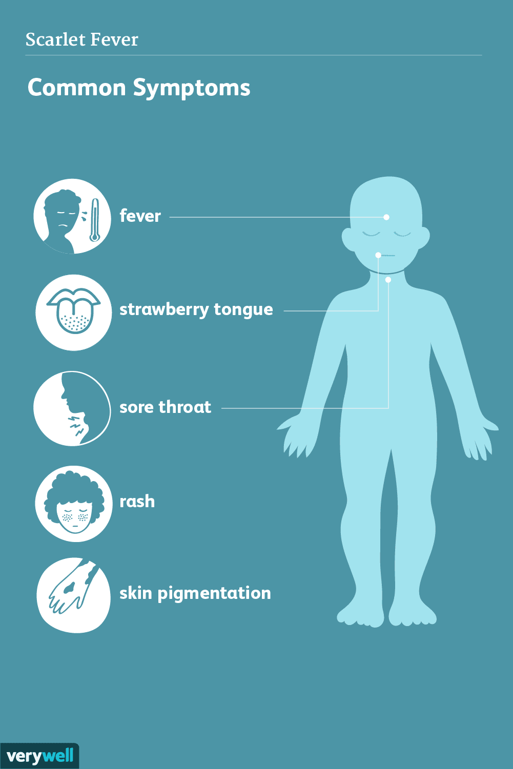 scarlet-fever-signs-symptoms-and-complicatons