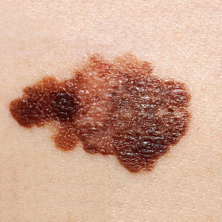 Photo Gallery Of Skin Cancer By Type   Close Up Of Skin Cancer 702544019 599d91cb68e1a200106c05b9 