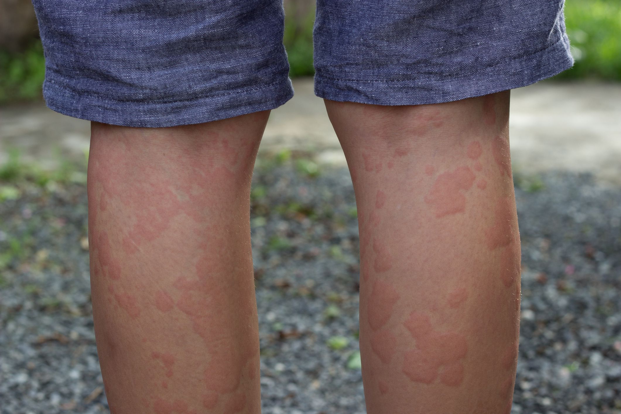 hives-and-heat-rash-diagnosis-and-treatment