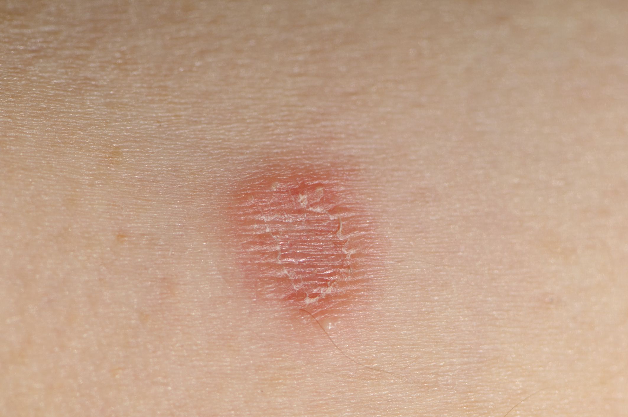 Causes, Symptoms and Treatment of Ringworm