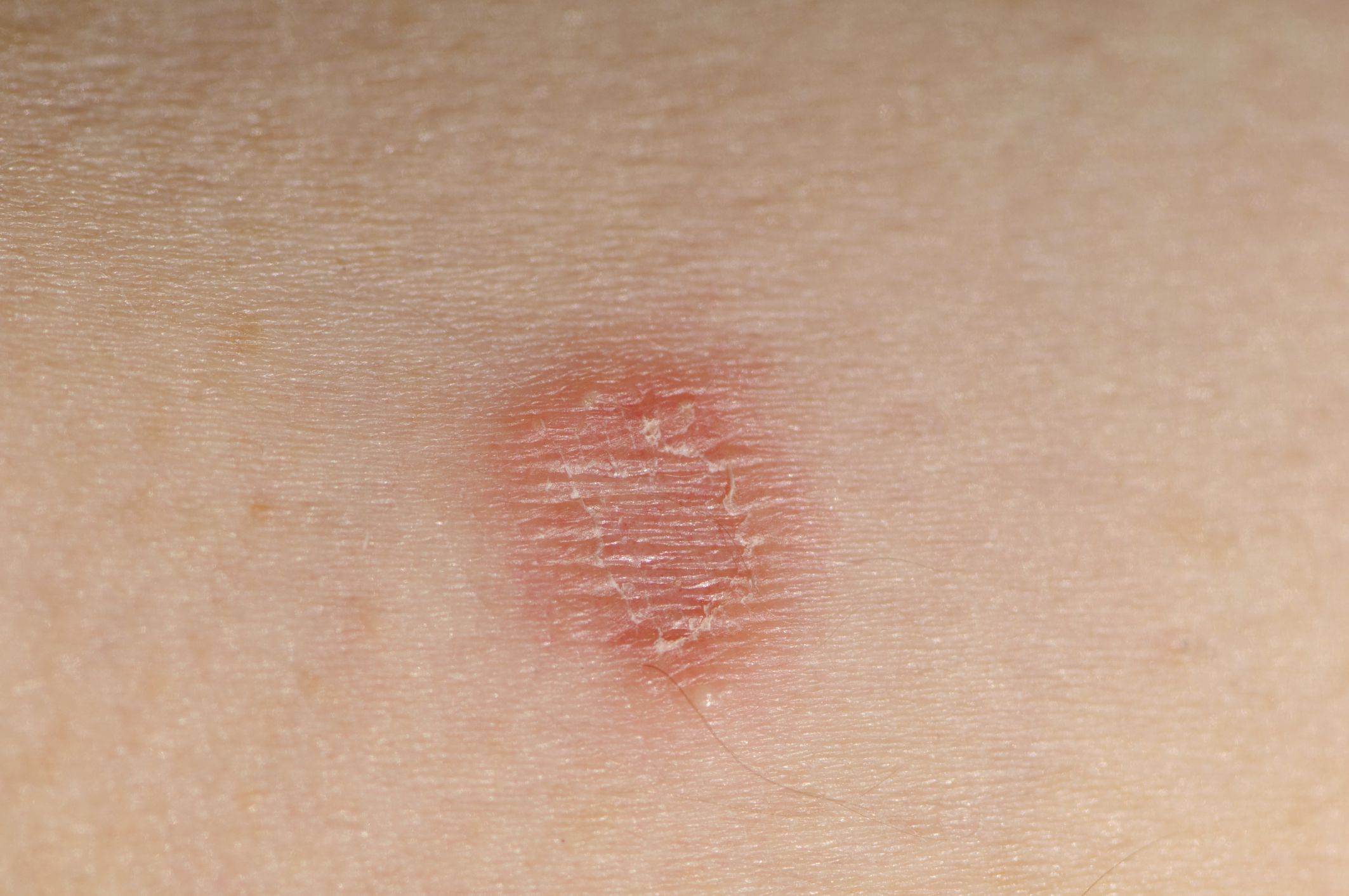 Causes Symptoms And Treatment Of Ringworm