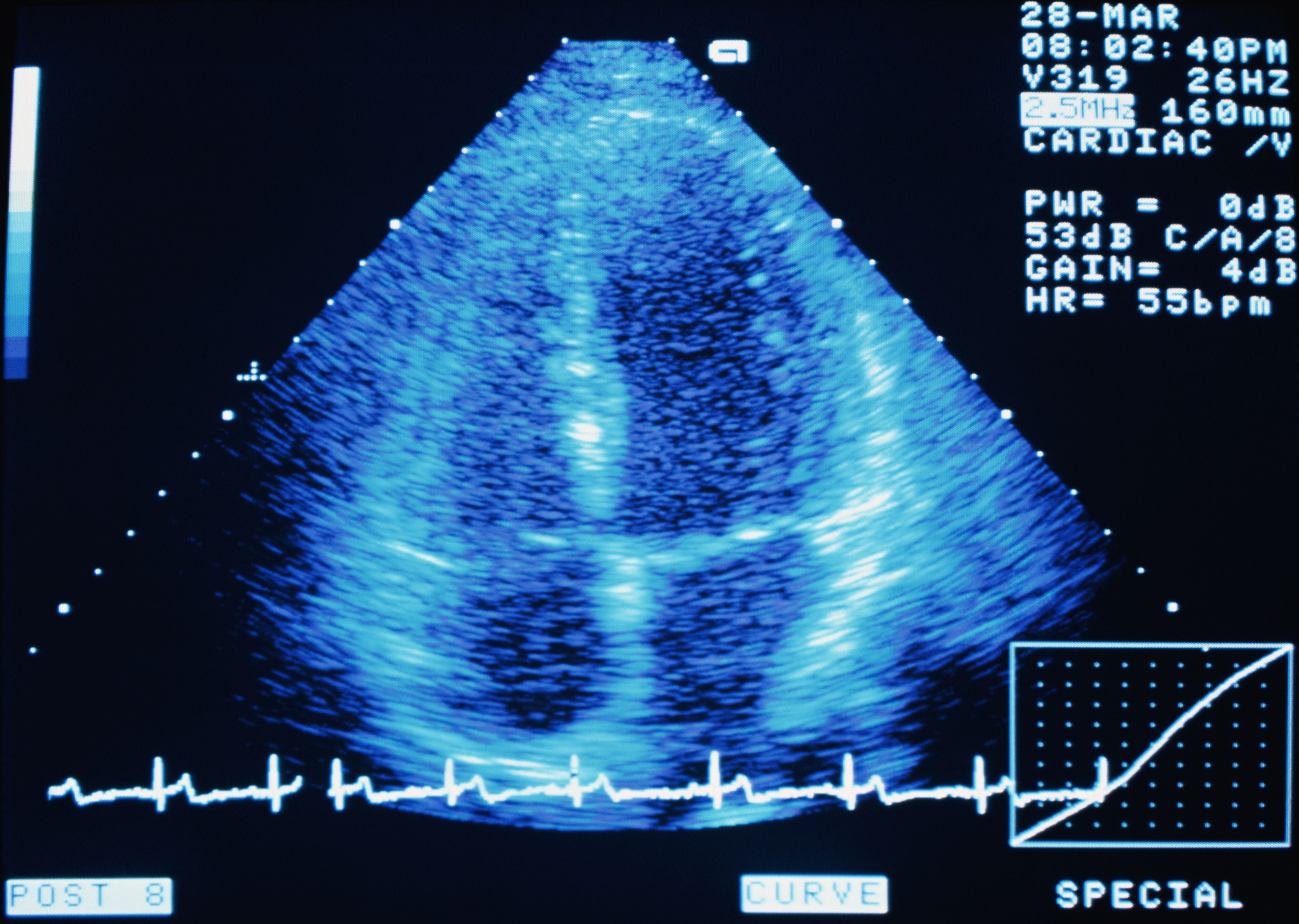 The "Bubble Study" For Patent Foramen Ovale