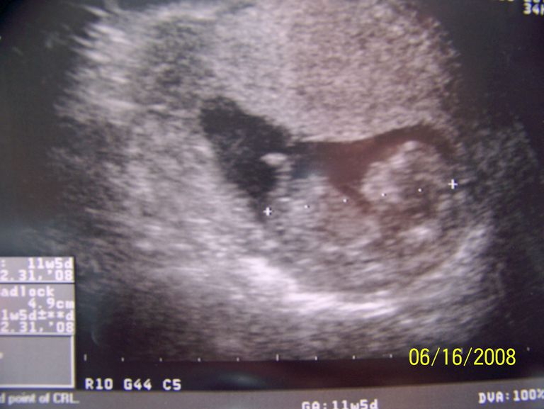 11 Weeks Pregnant Early Pregnancy First Trimester