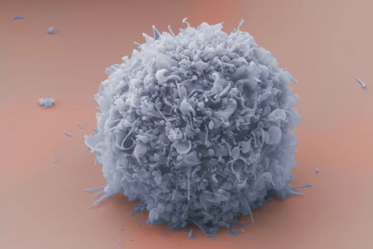 A cell's inability to undergo apoptosis can result in the development of cancer cells, such as this human breast cancer cell