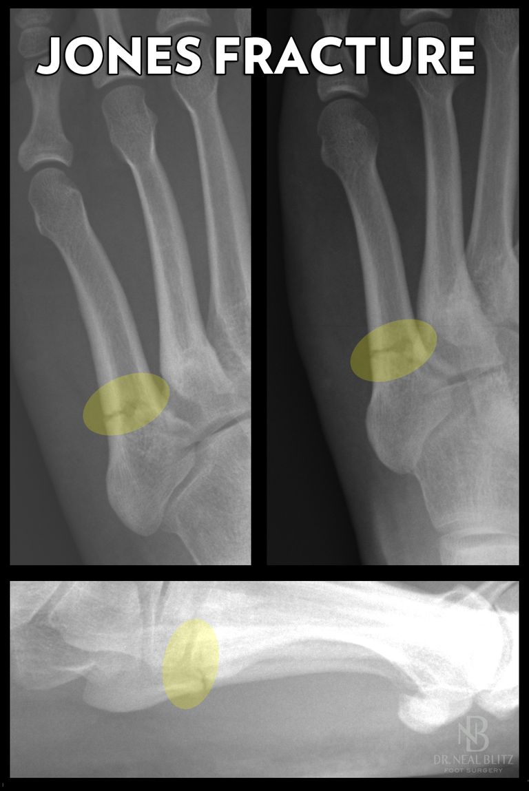 understanding-the-jones-fracture-of-the-foot