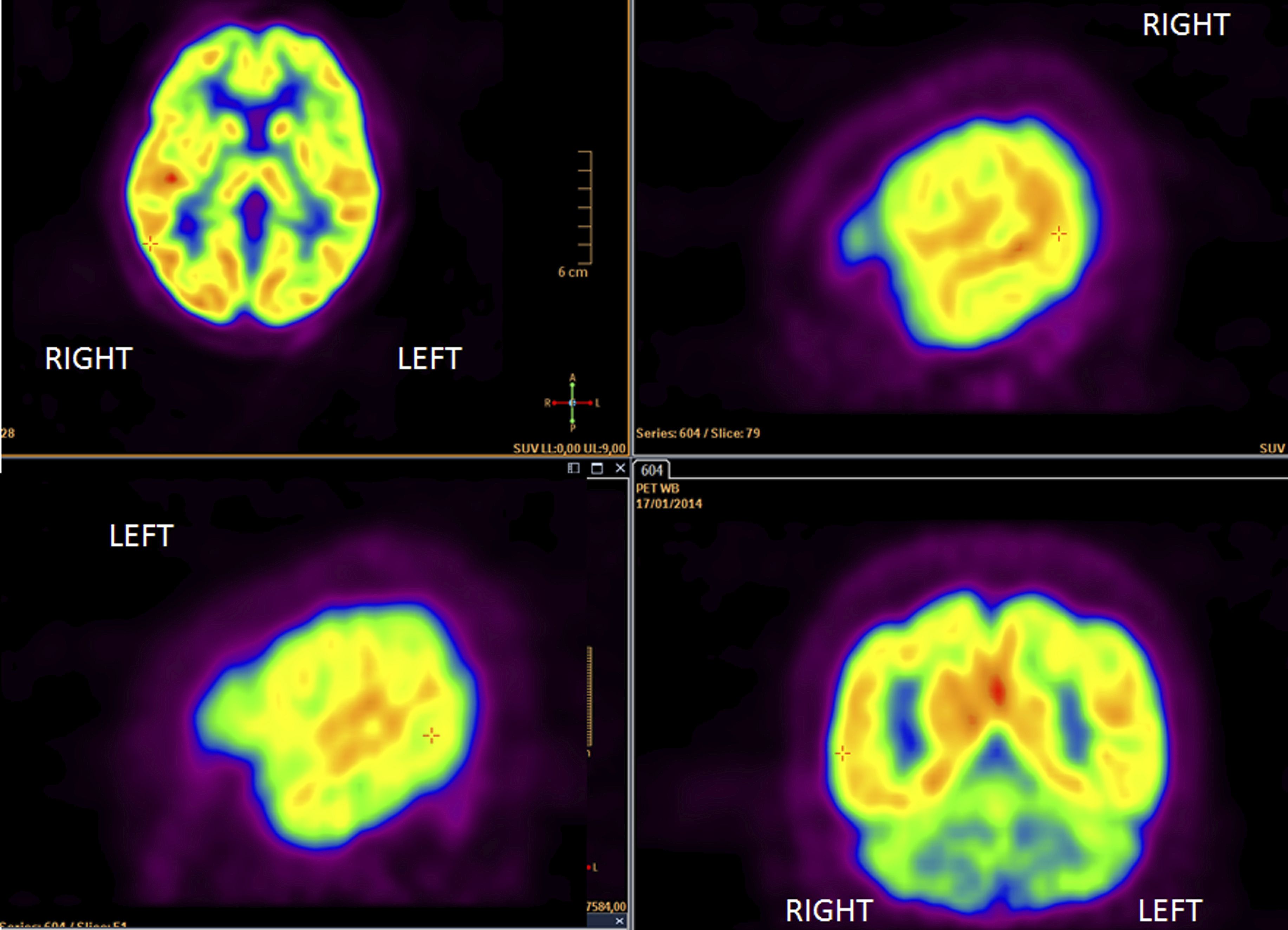 how-a-pet-scan-can-diagnose-lung-cancer