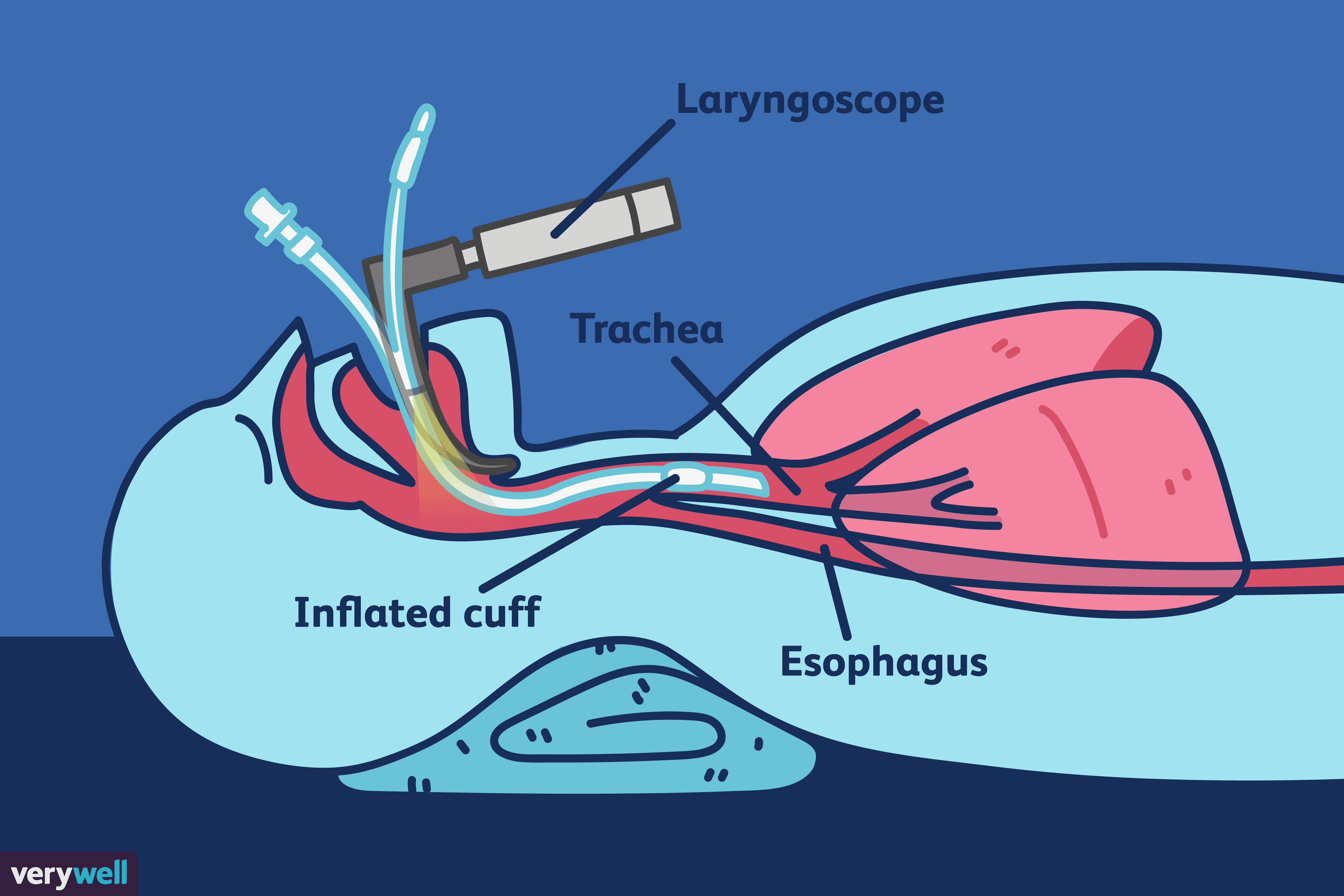 What Is Intubation and Why Is It Done?