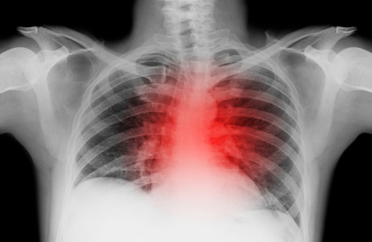 Cardiomegaly is an Enlarged Heart