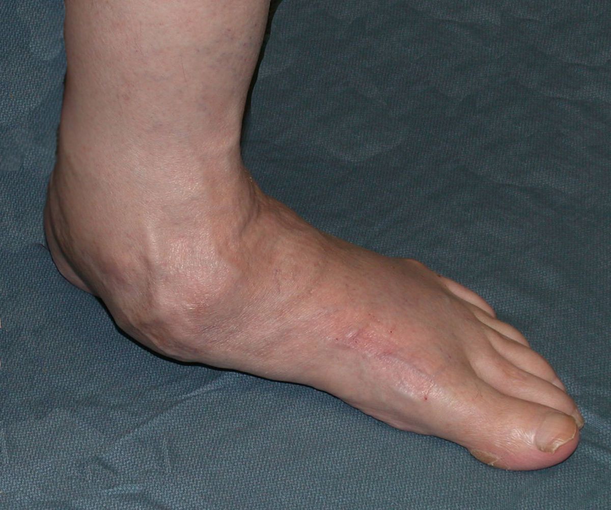 flat feet treatment