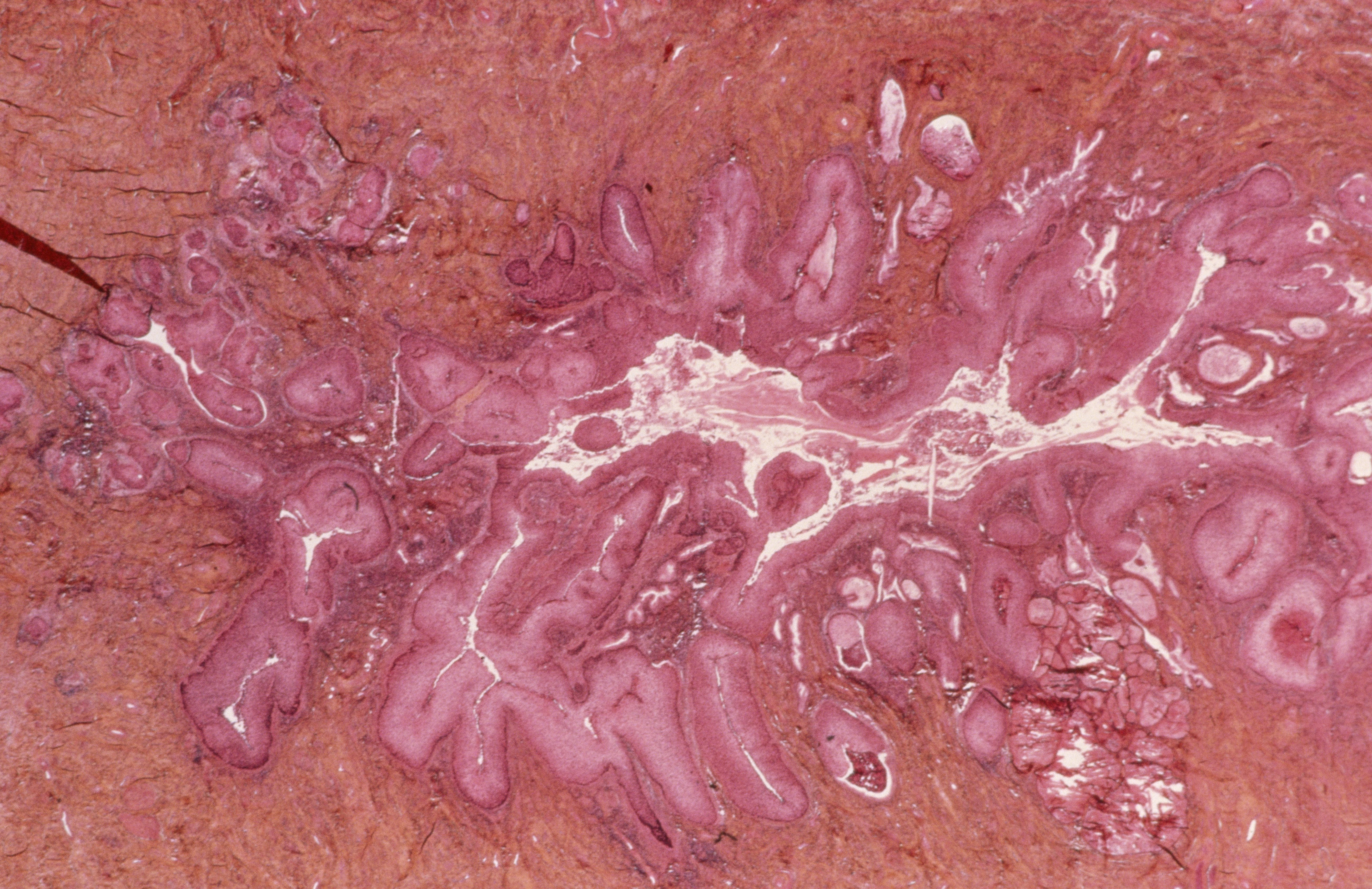 What to Know About Cervical Intraepithelial Neoplasia5215 x 3382