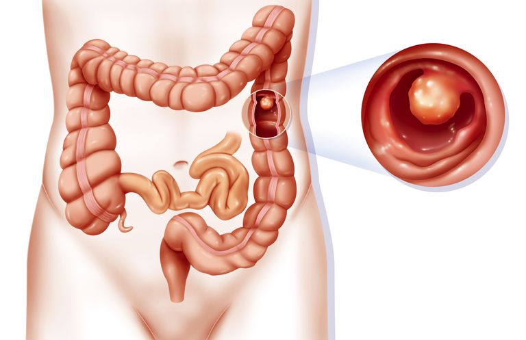 what-are-the-different-types-of-colon-polyps