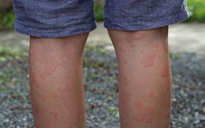 Treatment Options for a Heat Rash