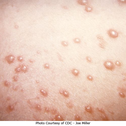 fever how to reduce pregnant Treatment, Chickenpox: Prevention Pictures, Symptoms, and