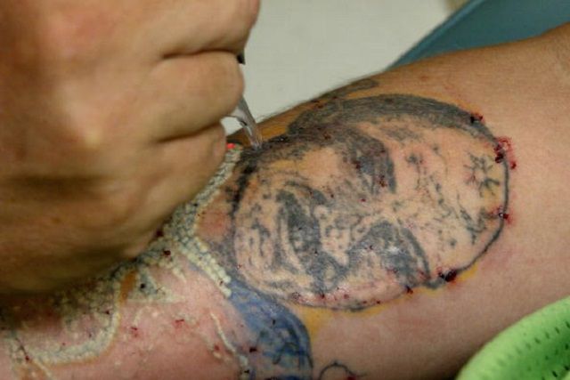 Frequently Asked Questions About Laser Tattoo Removal