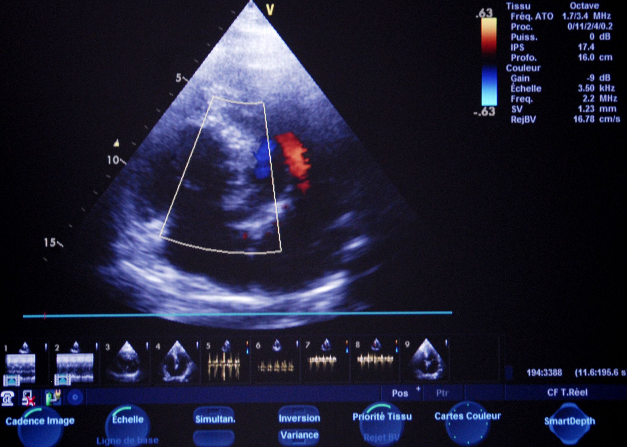 Eco doppler vascular