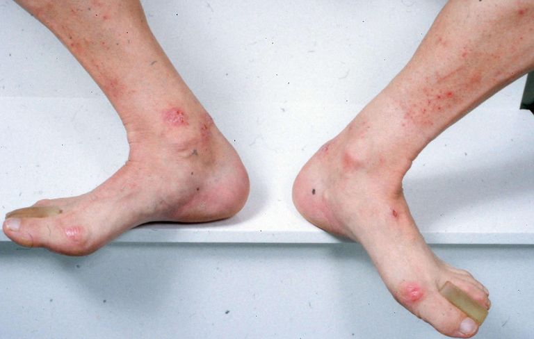 dermatitis-herpetiformis-celiac-disease-rash-photos