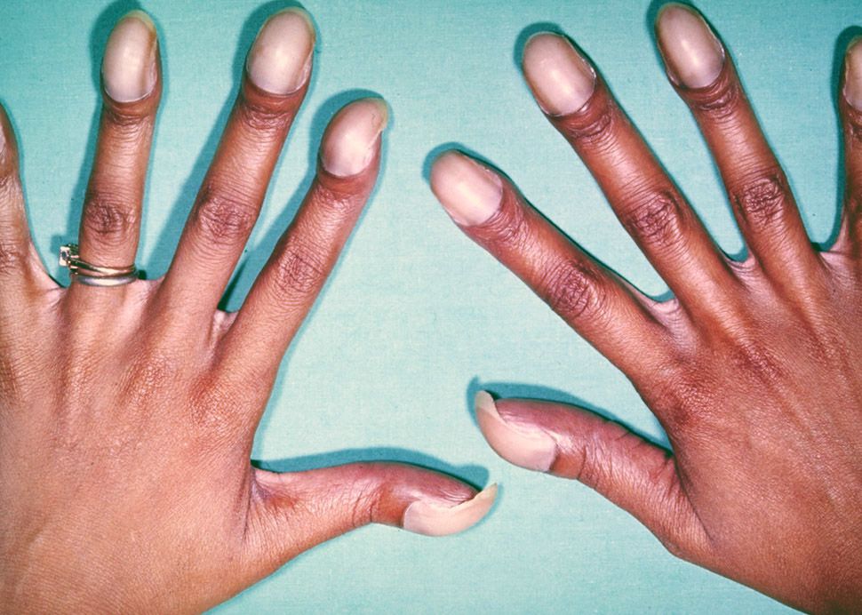 clubbing-of-the-fingers-causes