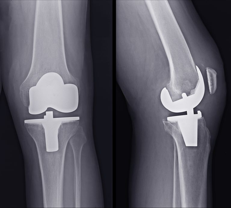 How Rheumatoid Arthritis Affects Each Part of the Body