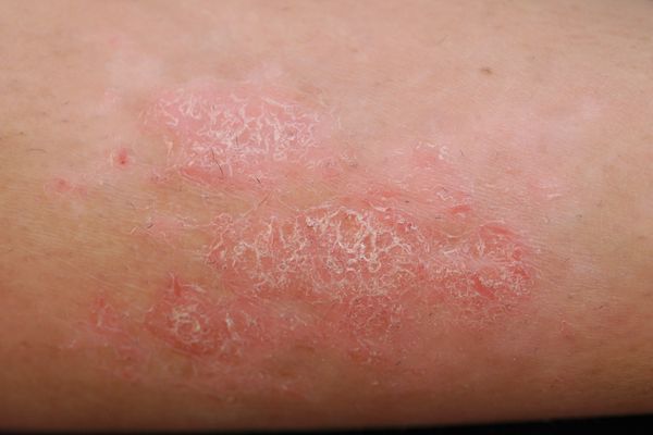 Psoriasis - Symptoms, Treatment, and More