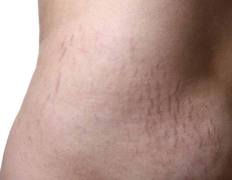 stretch-marks-after-weight-loss-do-they-go-away