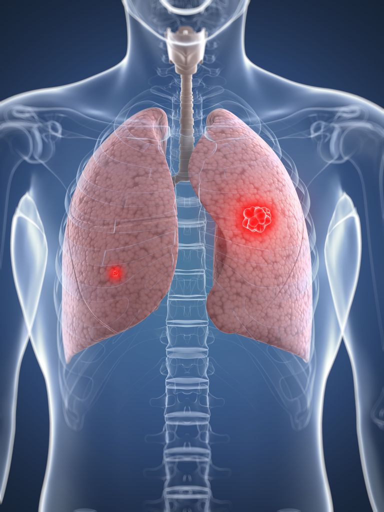 Copd Risk Of Lung Cancer - Perokok w