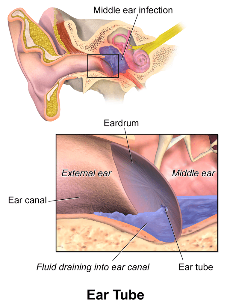 Tubes In Adult Ears 60