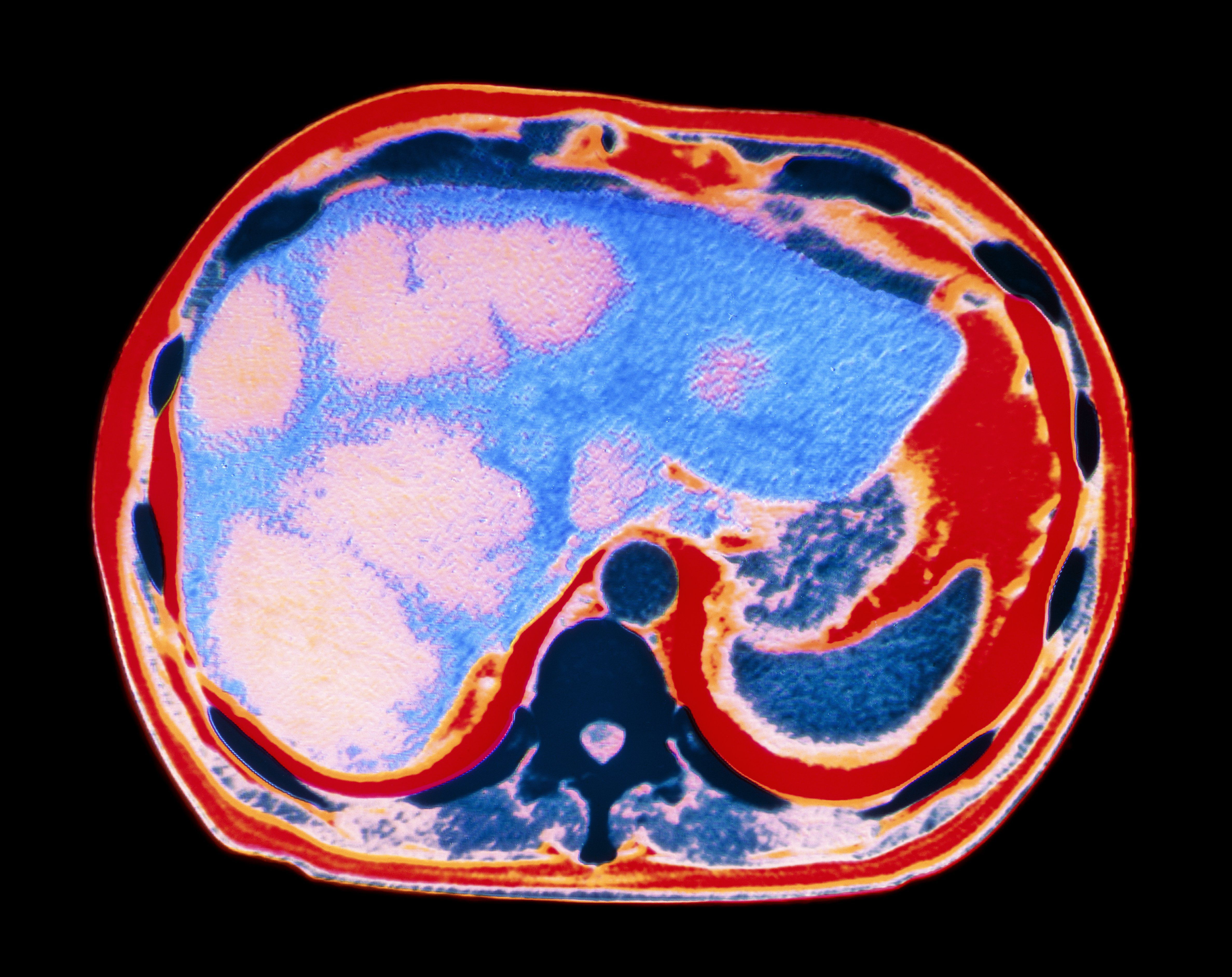 types-of-cancer-caused-by-drinking-alcohol