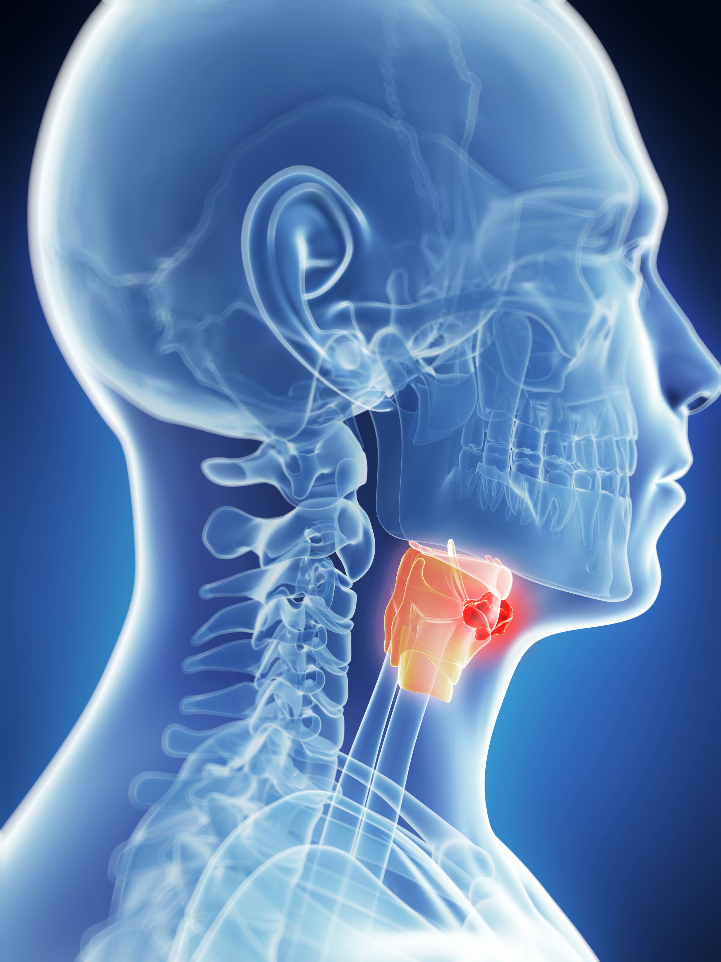 Laryngeal Cancer Treatment and Prognosis