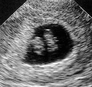 A view from the 8th week of pregnancy via ultrasound.