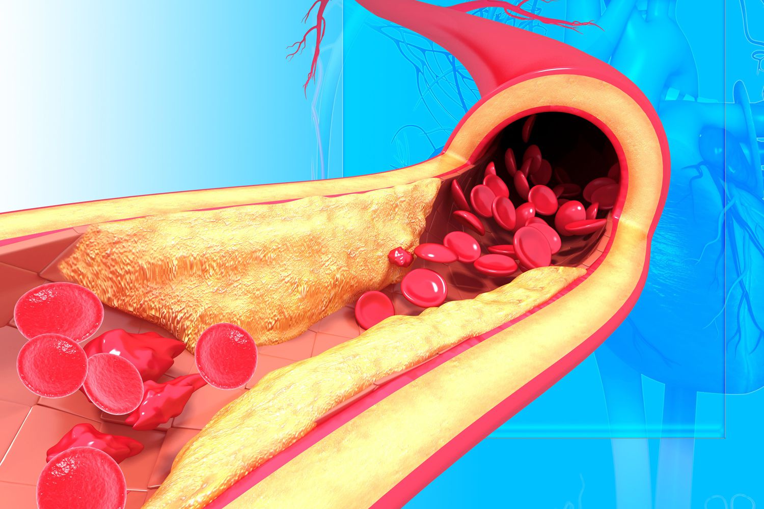 What Does It Matter If You Have High Cholesterol?