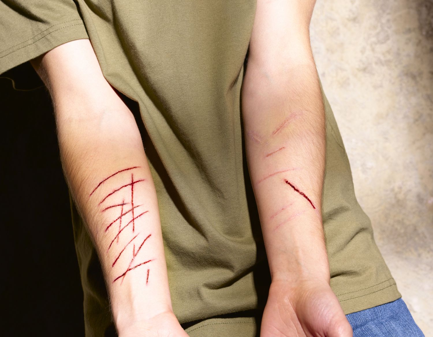 cutting-and-other-forms-of-ptsd-self-mutilation