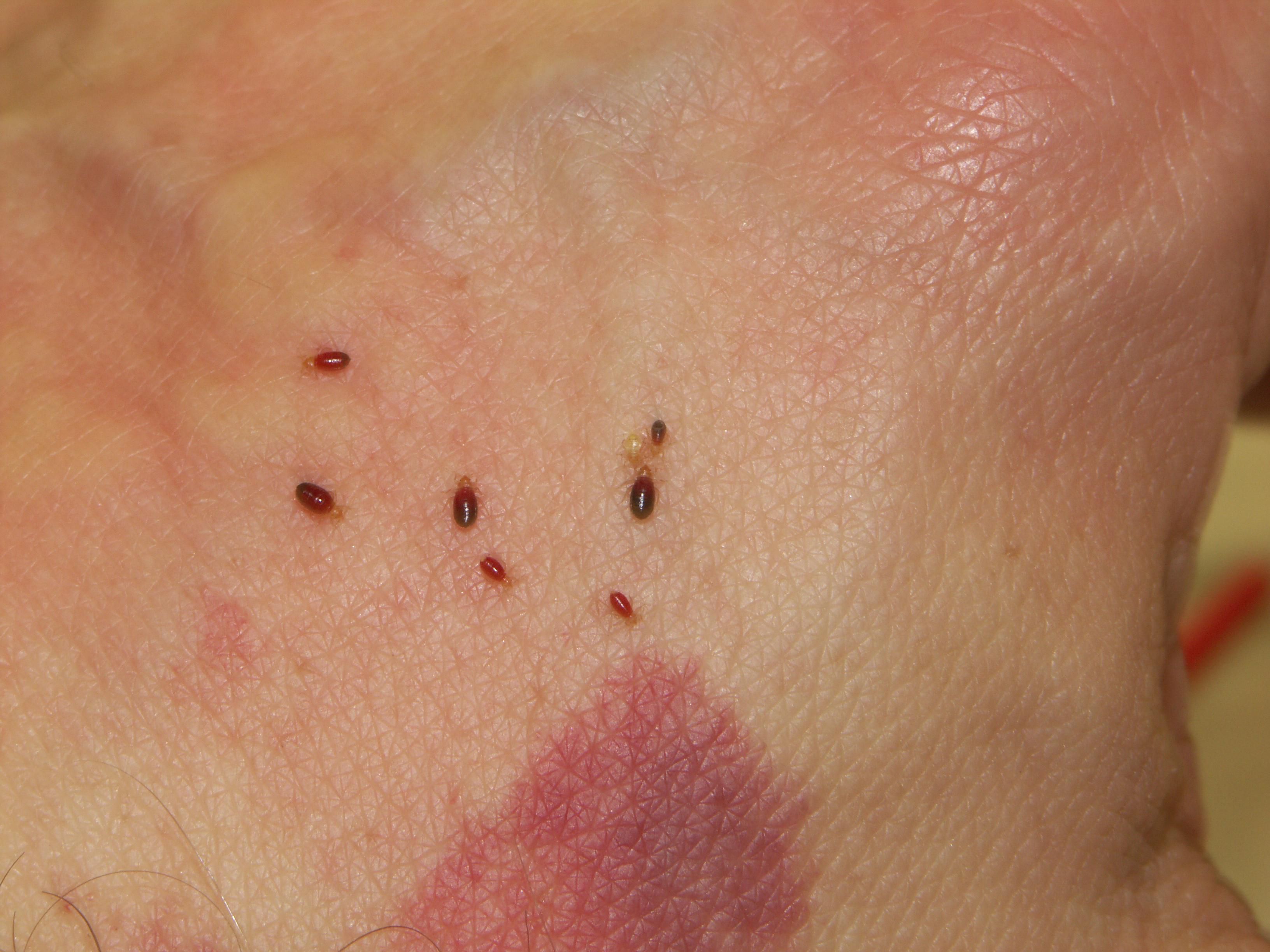 Orestes In Bed Bug Infestation Bites 46063 Bed Bug Defenders Indianapolis