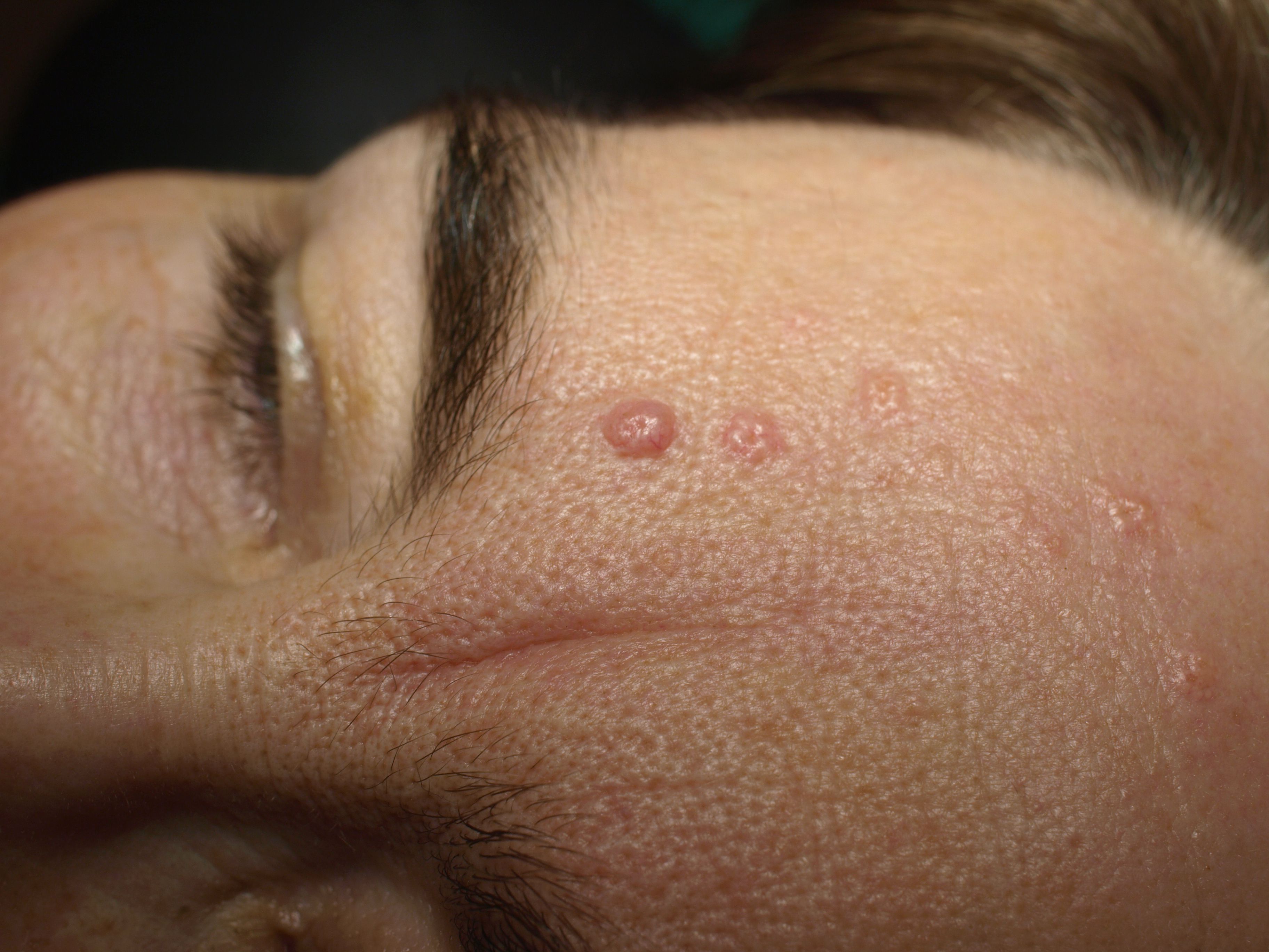 Sebaceous Hyperplasia Causes Symptoms And Treatments 