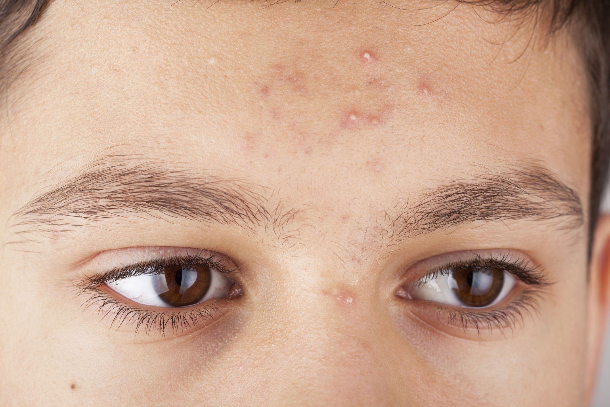 Acne Pustule Types Causes And Treatments