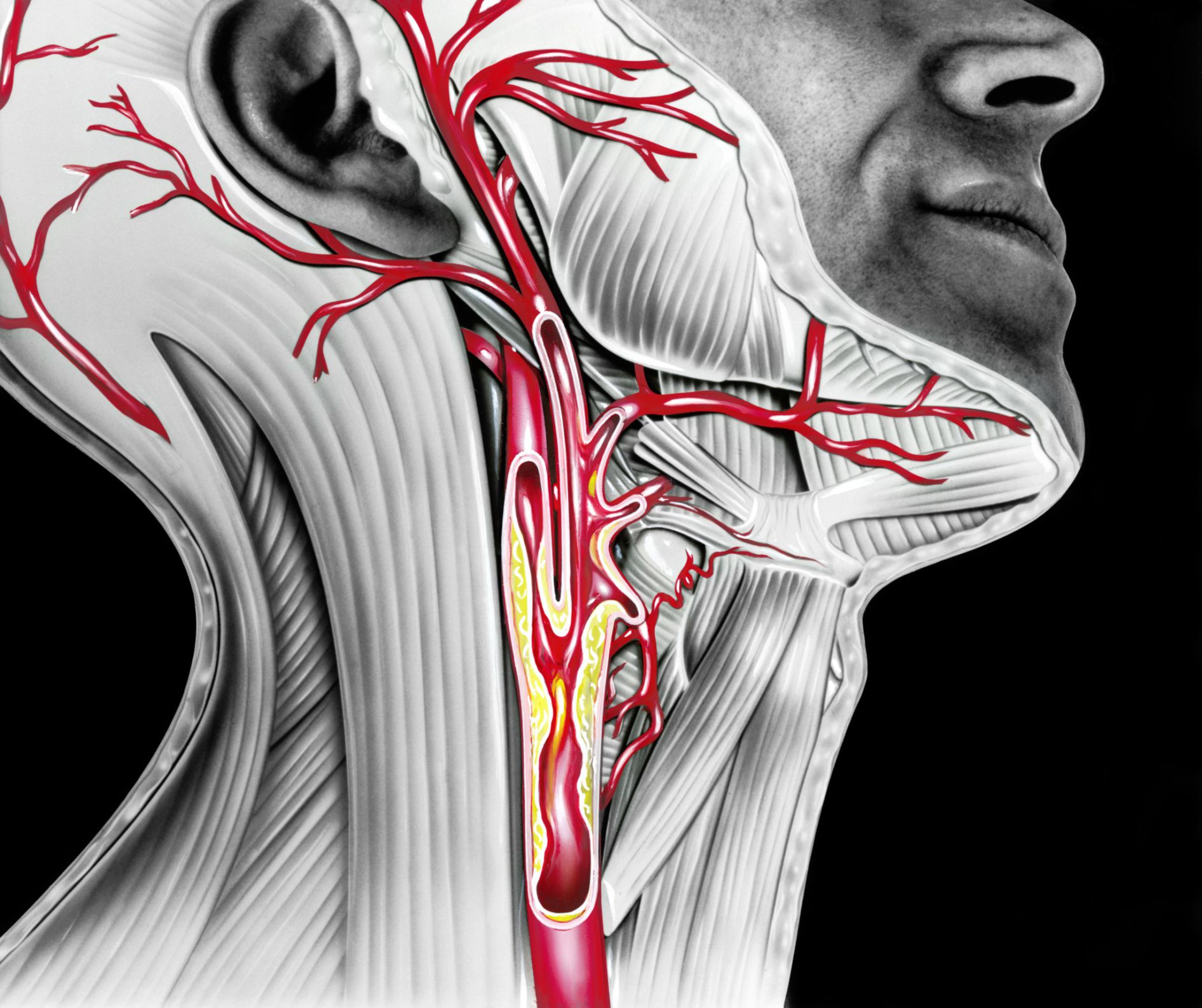 Carotid Stenosis Treatments