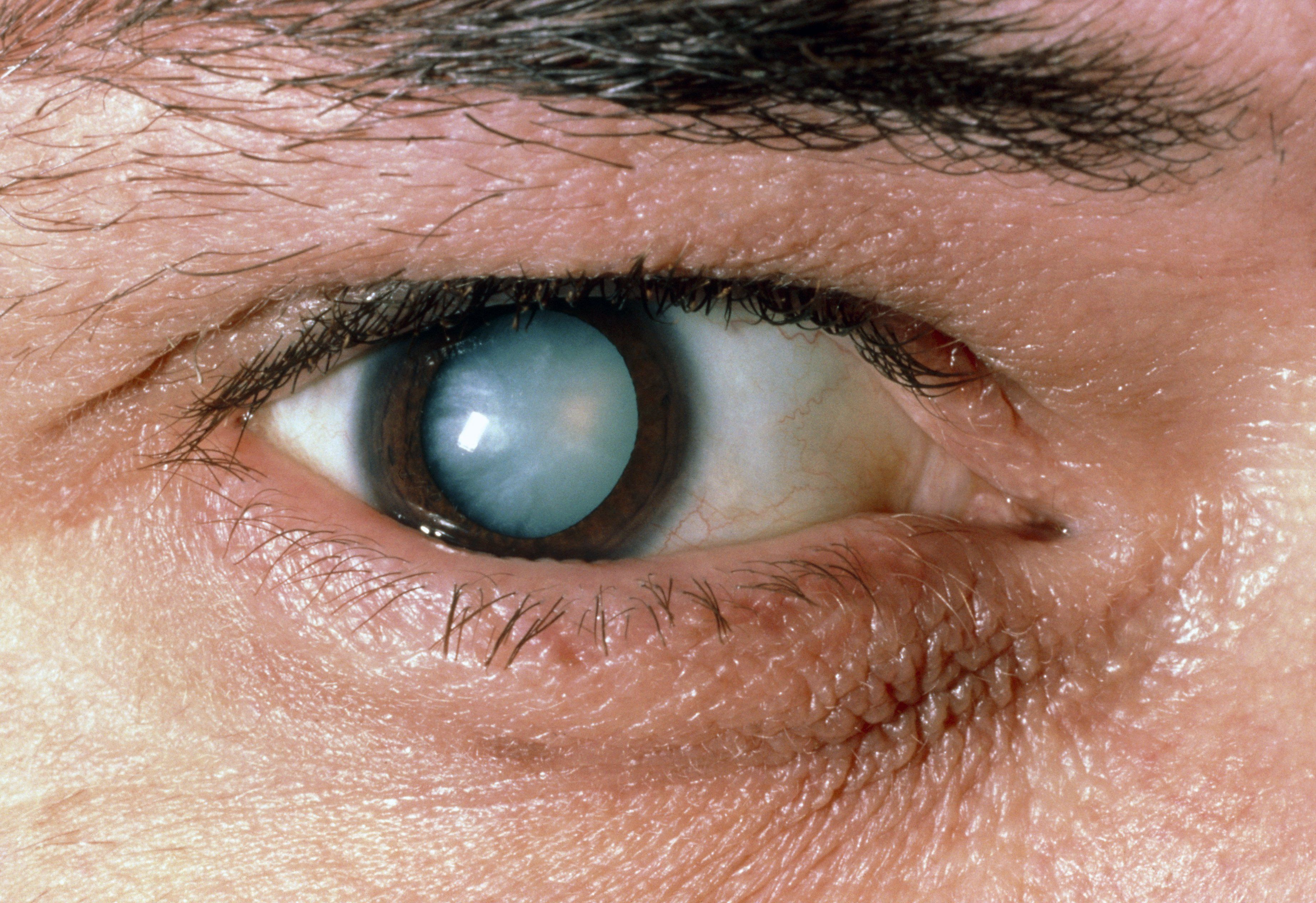 cataracts-diagnosis-and-treatment