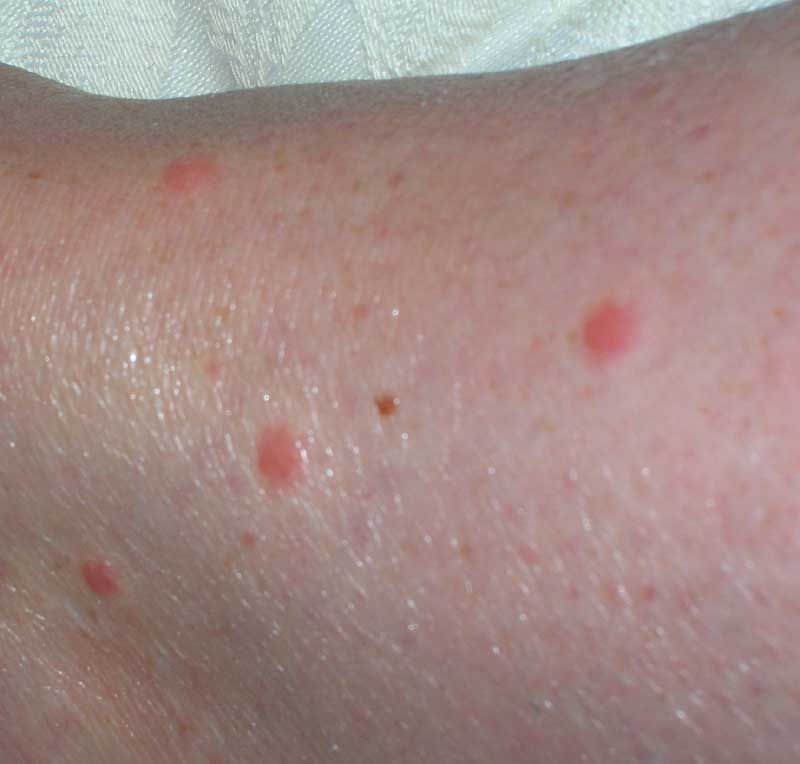 How To Know If You Have Bed Bug Bites   Clc Bed Bug Bites 56a4dffb5f9b58b7d0d9a1b5 