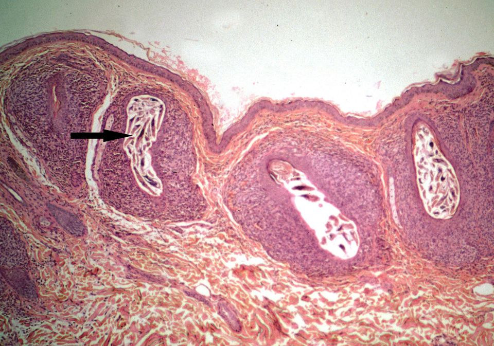 demodex humans - pictures