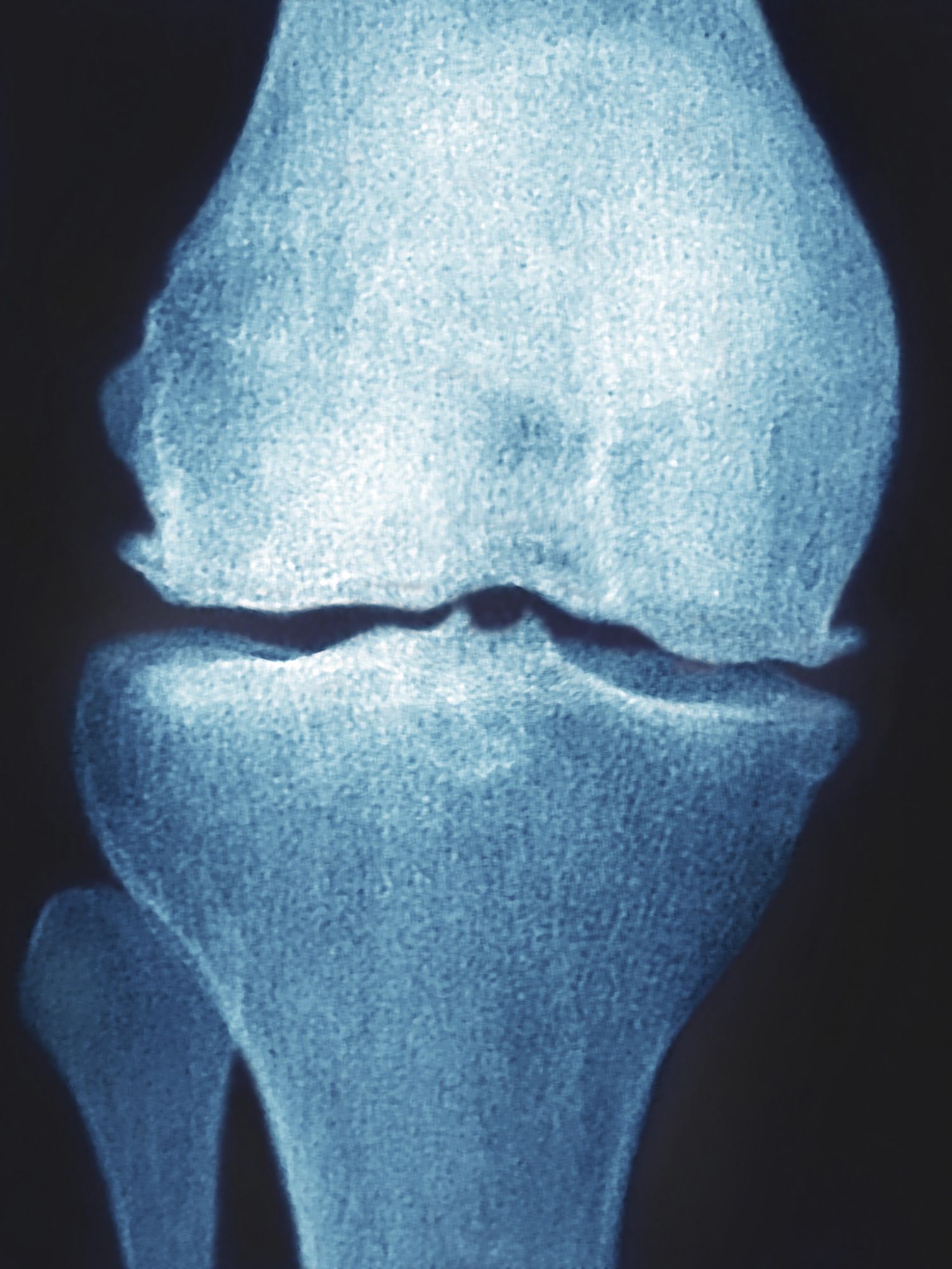 What Is An Osteophyte Bone Spur 2938