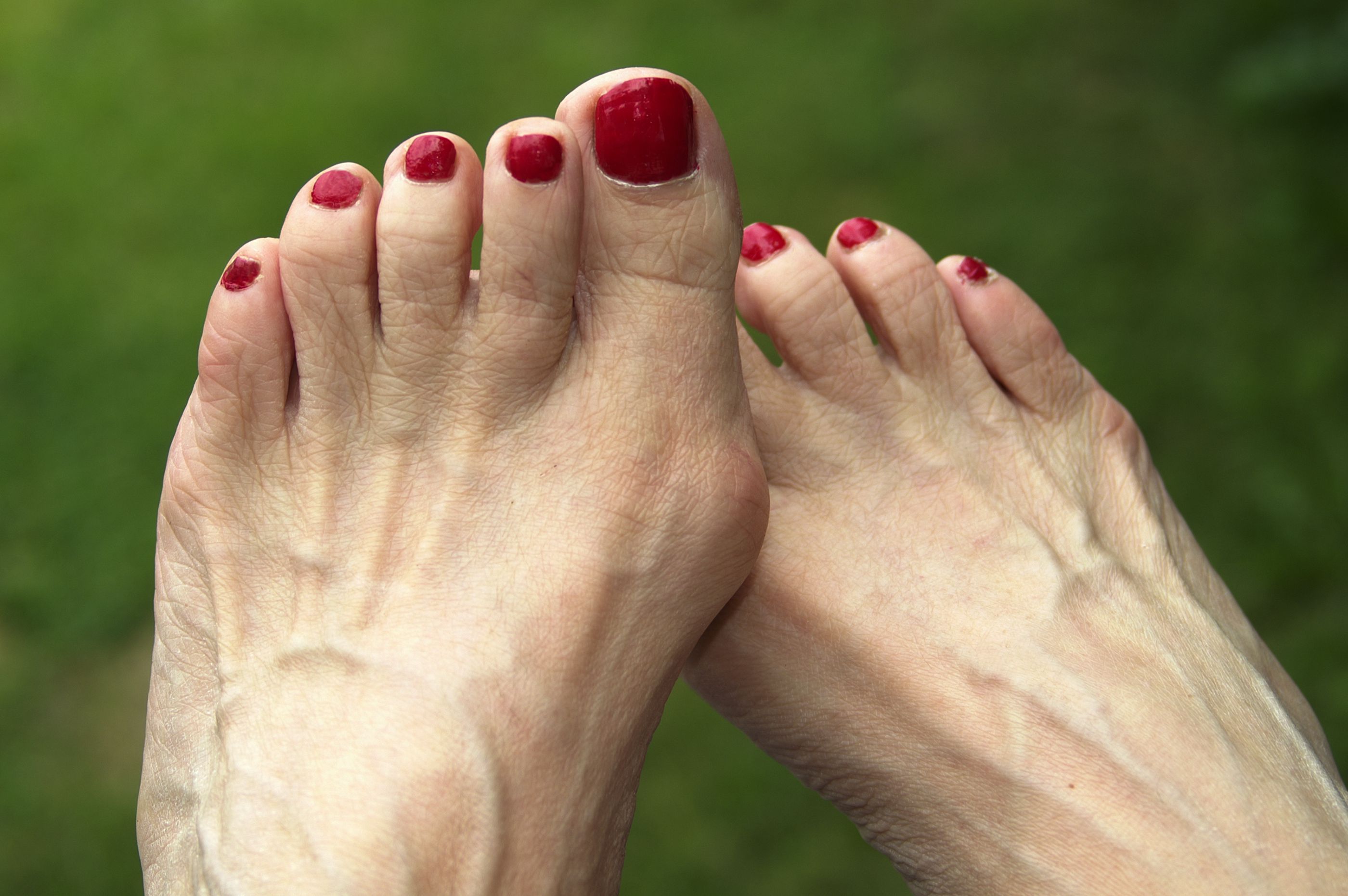 How To Get Rid Of Bunions On Baby Toe