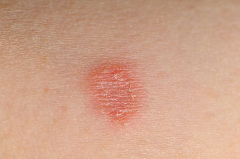 Ringworm In Kids Diagnosis And Treatment