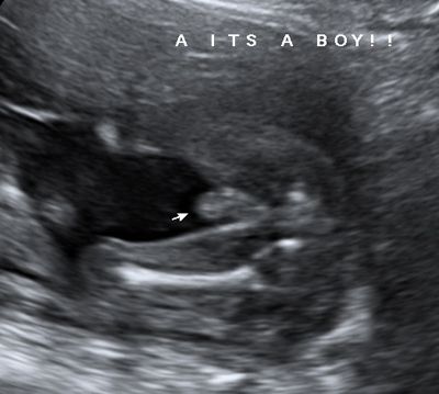 Ultrasound Photo Gallery - Pregnancy 3D Ultrasounds