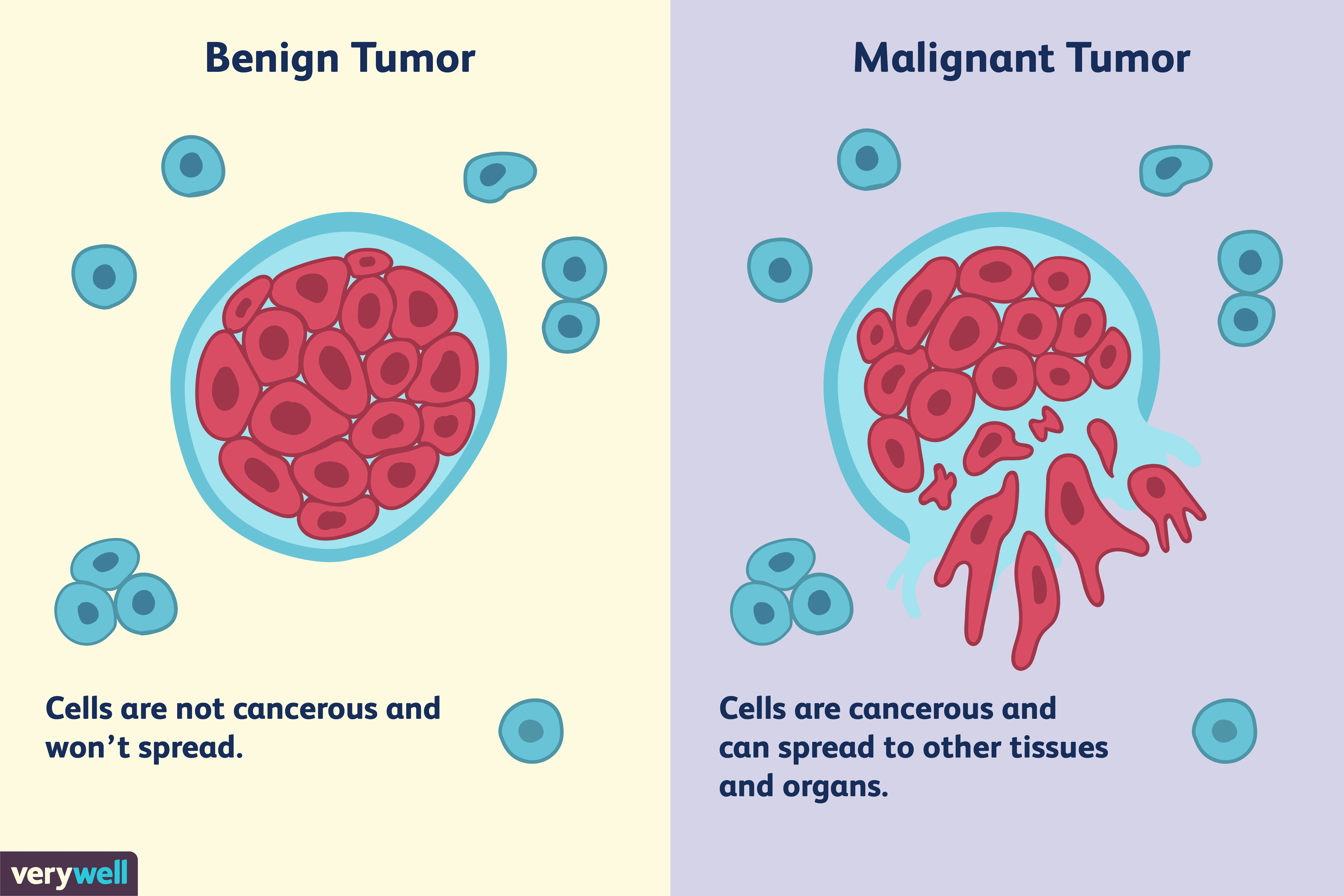 differences-between-a-malignant-and-benign-tumor